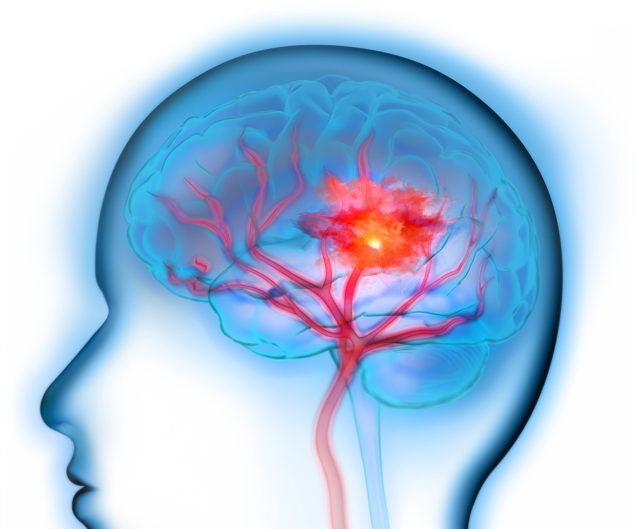 뇌졸중은 일교차가 큰 환절기 각별히 주의해야 할 질환 중 하나다. 이미지= 서울대병원